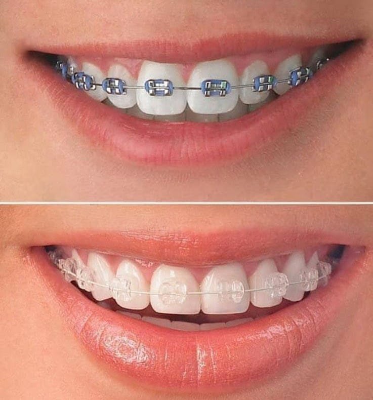 Orthodontic Treatment