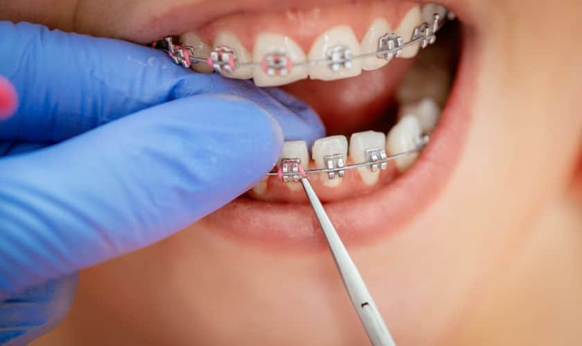 Orthodontic Treatment